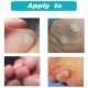 Unguisan Anti horn - Ingrown Nail Corns Calluses Remover 10ml